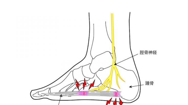 足底筋膜炎でお悩みのあなたへ